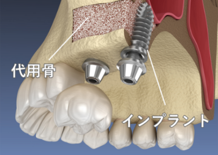 ソケットリフト