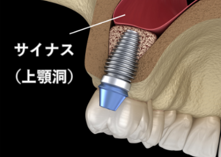 サイナスリフト